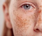 Изображение Веснушки на лице: почему появляются и как избавиться